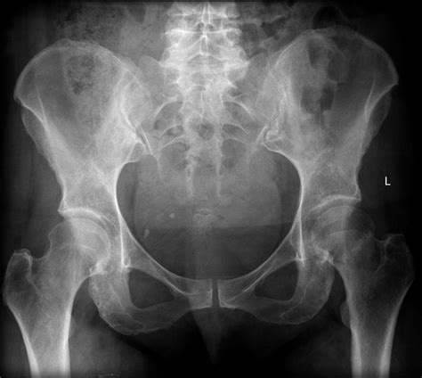 Icd 10 for left femoral neck fracture. Things To Know About Icd 10 for left femoral neck fracture. 